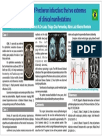 Artery of Percheron Infarction: The Two Extremes of Clinical Manifestations.