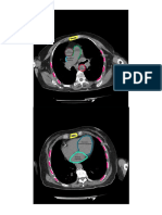 Esternon: Tronco Pulmonar Aorta Ascendente