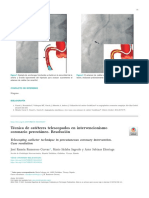 Técnica de Catéteres Telescopados en Intervencionismo Coronario Percutáneo. Resolución