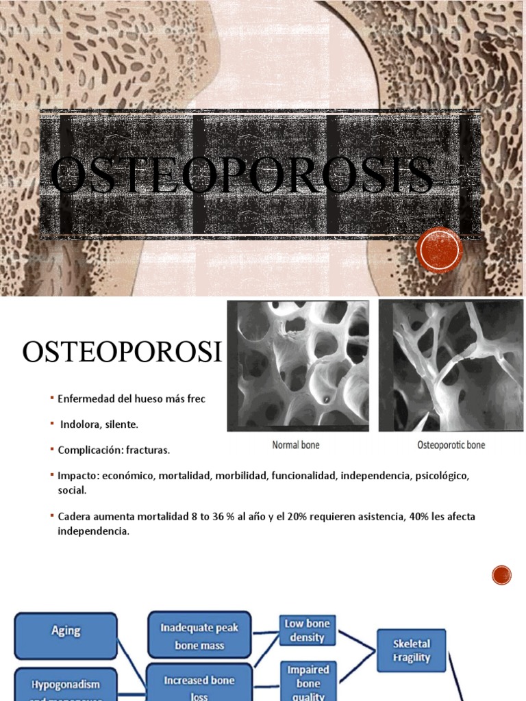 Guía Completa sobre Osteoporosis y Tratamientos | PDF | Osteoporosis ...