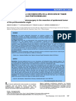 MICROCIRUGÍA ASISTIDA CON ENDOSCOPÍA EN LA RESECCIÓN DE TUMOR EPIDERMOIDE DEL ÁNGULO PONTOCEREBELOSO Spanish