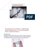 Periodontal Pockets Classification and Types