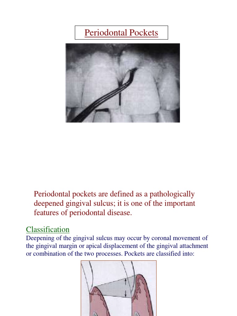 Periodontal Pockets PDF Periodontology Dentistry