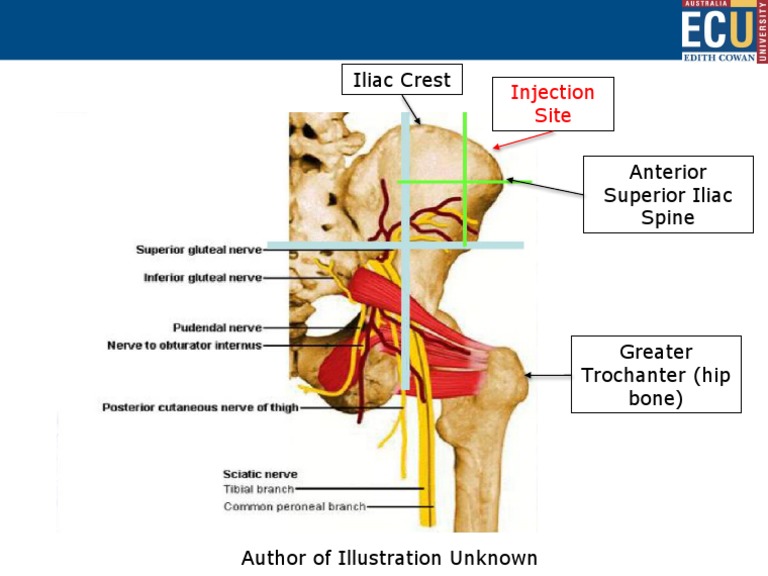 Im Injection Gluteal