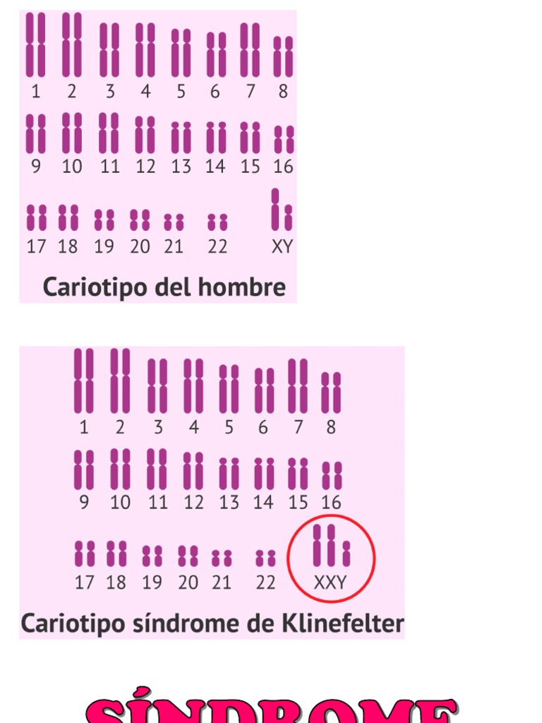 SÍNDROME DE KLINEFELTER | PDF