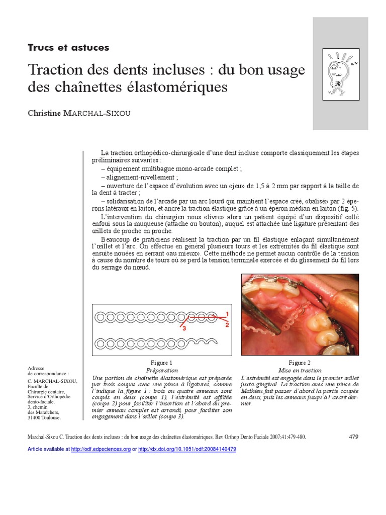 Traction Des Dents Incluses - Du Bon Usage Des Chaînettes ...