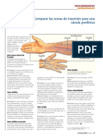 Comparar Las Zonas de Inserción para Una Cánula Periférica: Intravenosos