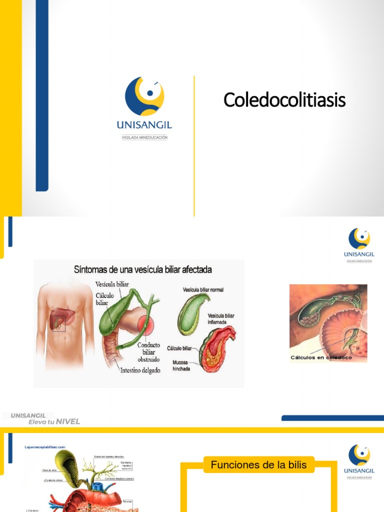 Coledocolitiasis: Causas y Tratamiento | PDF
