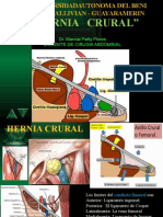 Hernia Crural