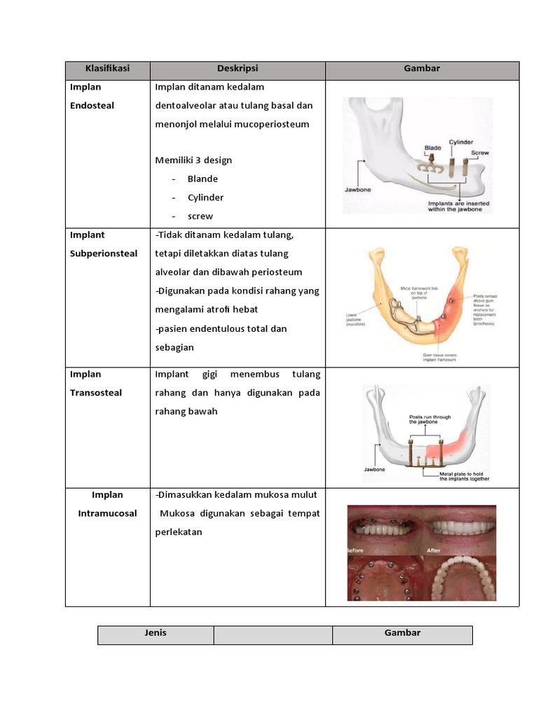 Klasifikasi Dental Implant PDF