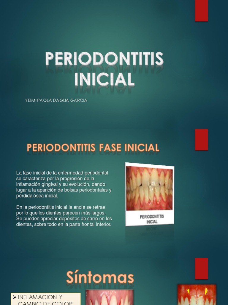 Periodontitis Inicial | PDF