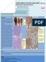 Sarcoma de células foliculares dendríticas EBV+ en pólipo intestinal