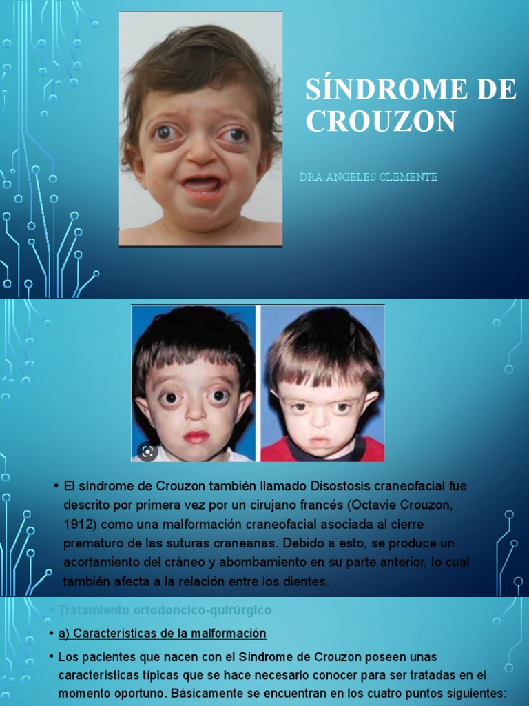 Sindrome de Crouzon 2 PDF