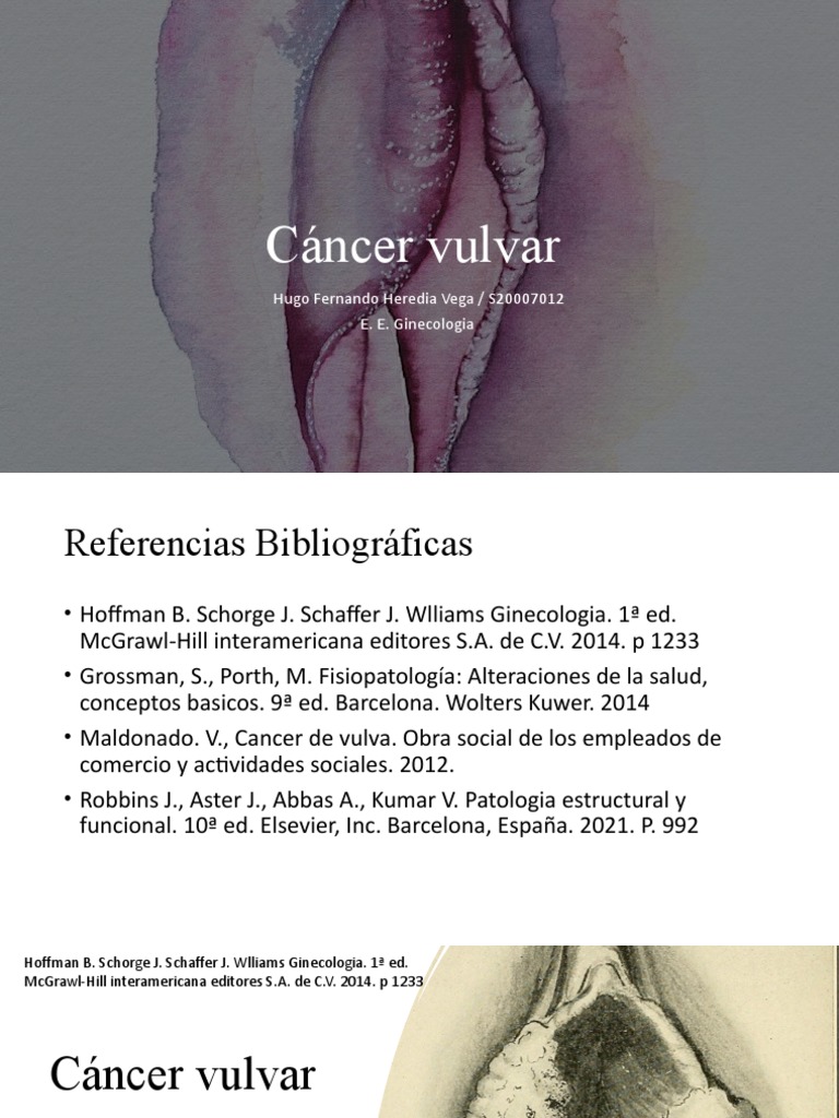 Cáncer Vulvar: Diagnóstico y Tratamiento | PDF | Cáncer | Metástasis