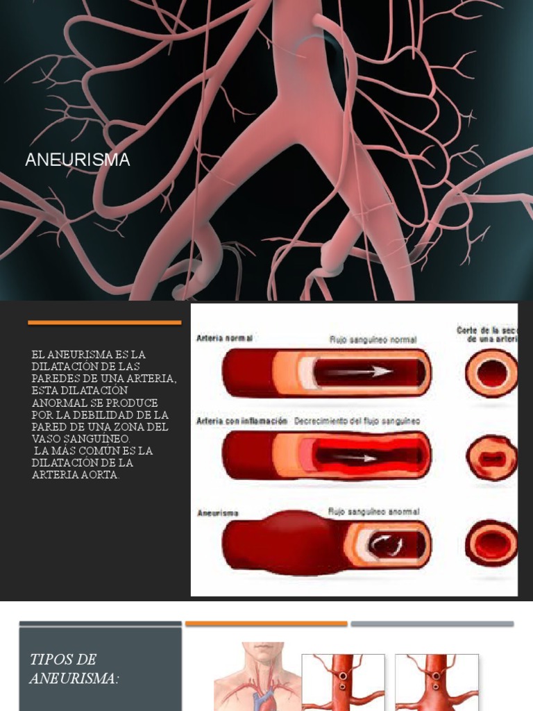 Aneurisma de Aorta Abdominal: Síntomas y Tratamiento | PDF | Aorta ...