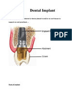 Dental Implant ClassNote