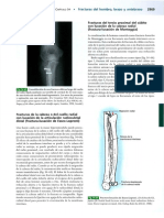 Del Del Cúbito Con Luxación de Radial (Fractura-Luxación de