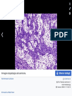 Testicular seminoma (1) nodal metastasis - Seminoma - Wikipedia
