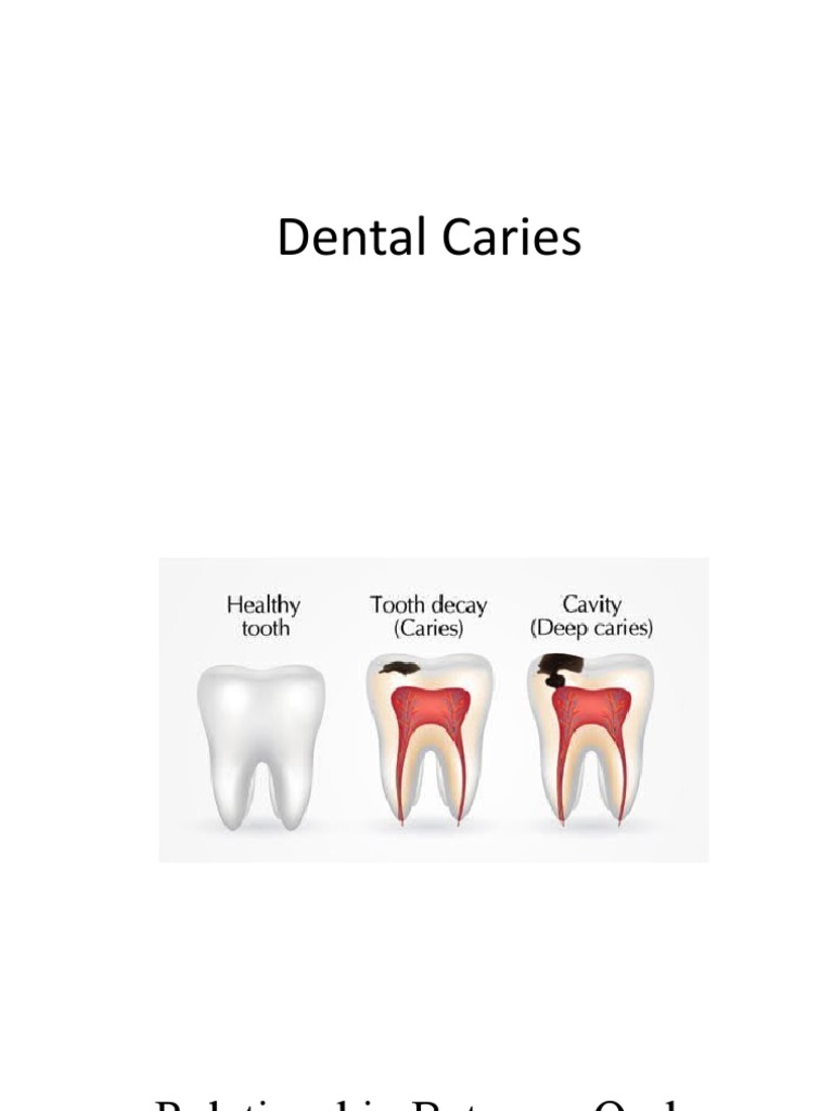 Dental Caries PDF