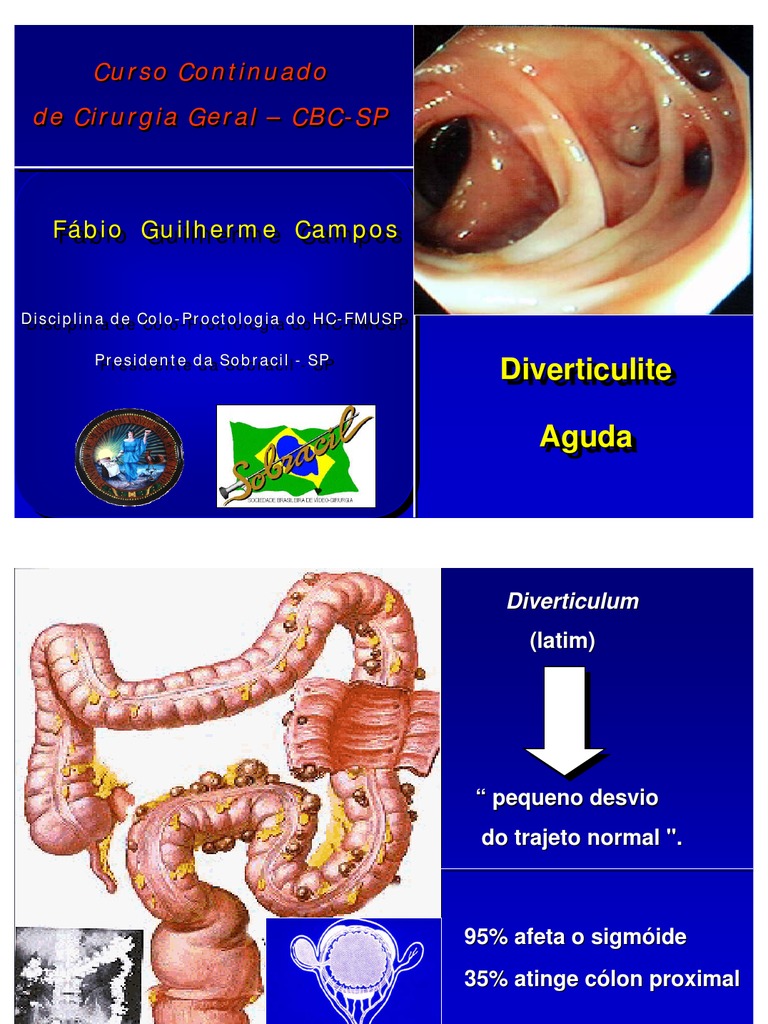 Diverticulite: Diagnóstico e Tratamento | PDF | Medicina Clínica ...