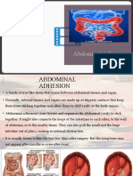 Abdominal Adhesion