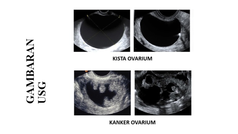 Gambaran Usg Ovarium | PDF