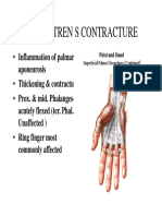 Dupuytren S Contracture: - Inflammation of Palmar - Thickening & Contractur - Prox. & Mid. Phalanges