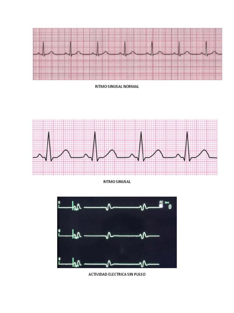 Arritmias y Desfibrilación Cardiaca | PDF