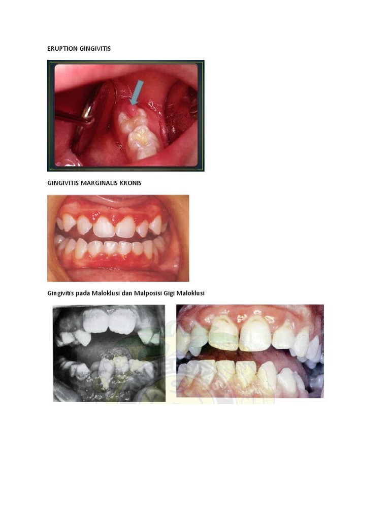 ERUPTION GINGIVITIS PDF