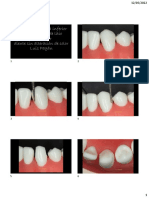 Preparación corona inferior Disilicato litio Full veneer diente sin alteración color