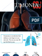 Pneumonia: Causes, Symptoms, Diagnosis and Treatment