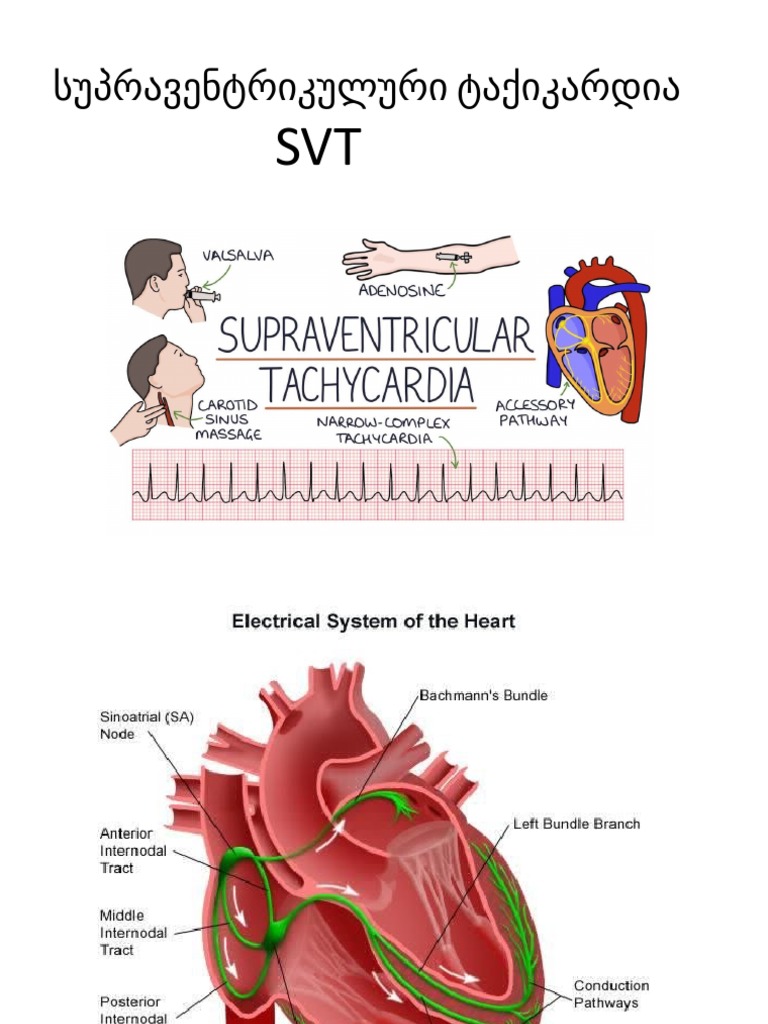 SVT | PDF