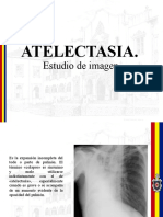 Atelectasia y derrame pleural