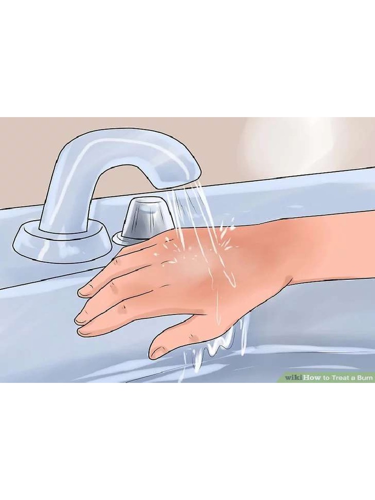 How To Treat A Burn! PDF