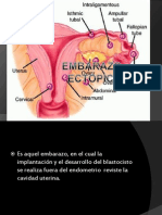 Embarazo Ectócpico