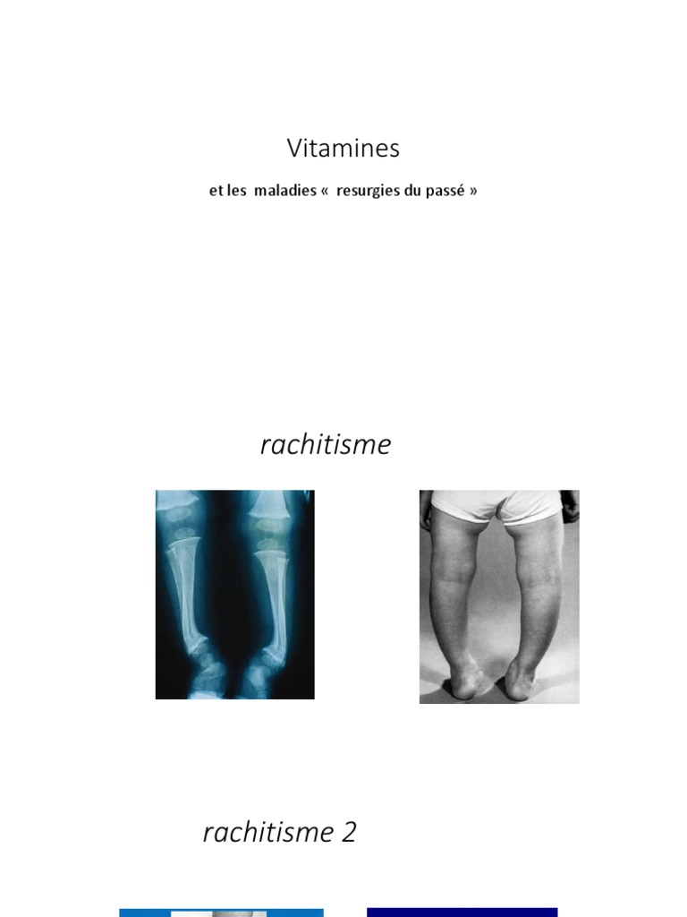 Rachitisme et carences vitaminiques | PDF | Vitamine | Vitamine B12