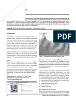 Managing Curved Canals: Keywords: Balance Forced Technique, Dilacerations, Precurved Files, Protaper