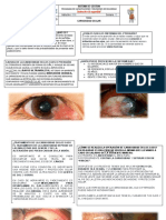 Boletin Carnosidad Ocular