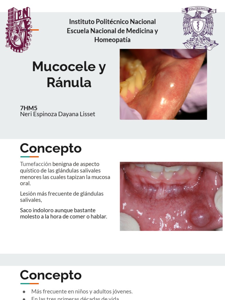 Diferencias entre Ránula y Mucocele | PDF | Anatomía | Enfermedades y ...