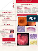 Gastritis y Helicobacter GMpylori