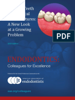 Cracked Teeth and Vertical Root Fractures: A New Look at A Growing Problem