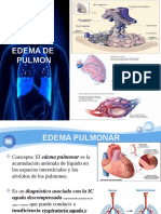 6.5 F Edema Pulmonar