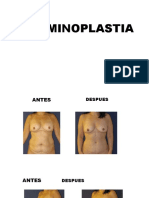 Abdominoplastia