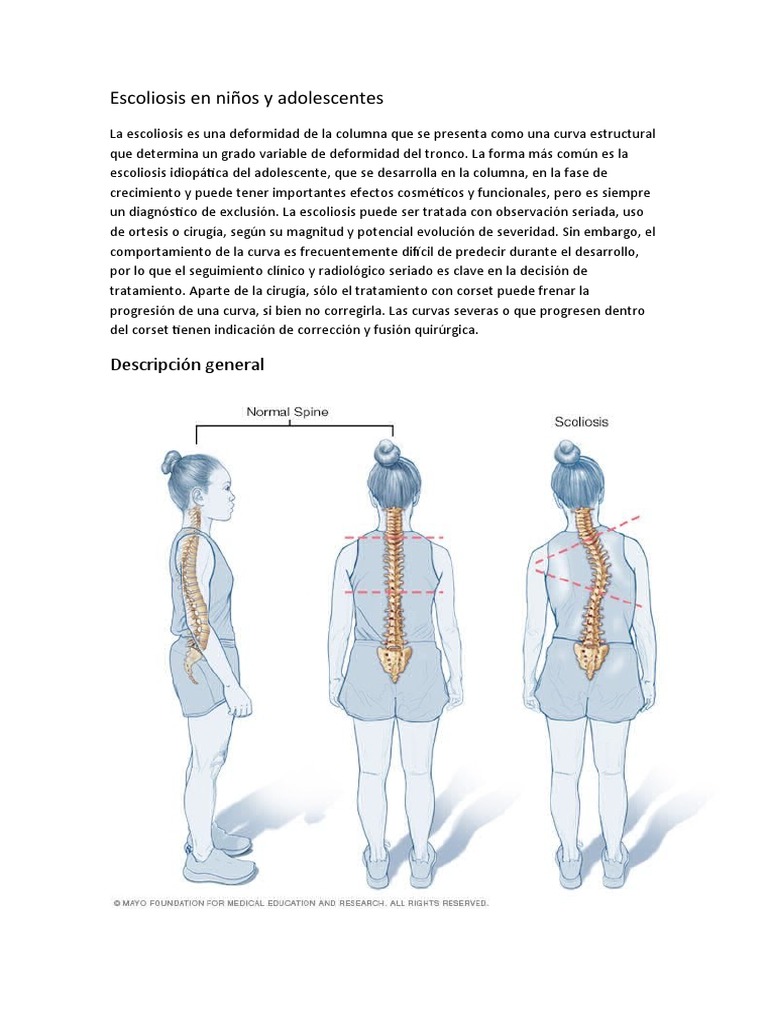 Escoliosis en Niños y Adolescentes | PDF | Escoliosis | La columna ...