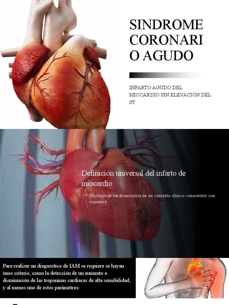 Diagnóstico y Tratamiento del IAM SCASEST | PDF | Infarto de miocardio ...