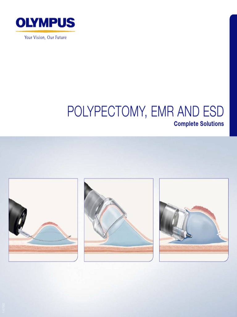 Polypectomy Emr and Esd | PDF | Endoscopy | Gastroenterology