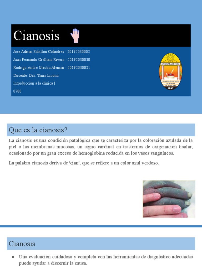 Cianosis: Coloración Azulada de la Piel | PDF | Defecto cardiaco ...