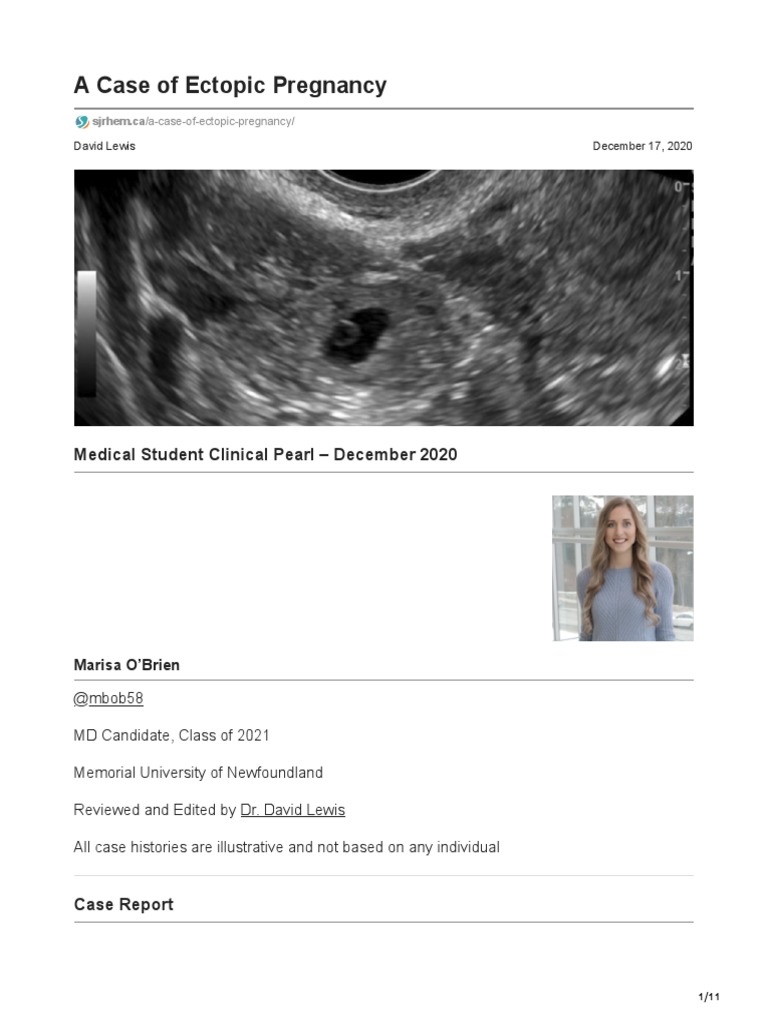 Sjrhem CaA Case of Ectopic Pregnancy PDF Pregnancy Health Sciences