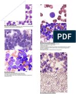 FAB Classification of Acute Myelogenous Leukemia (AML)