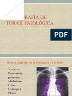 Radiografía de tórax patológica: opacidades y sombras